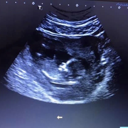 Baby Gundoo scan